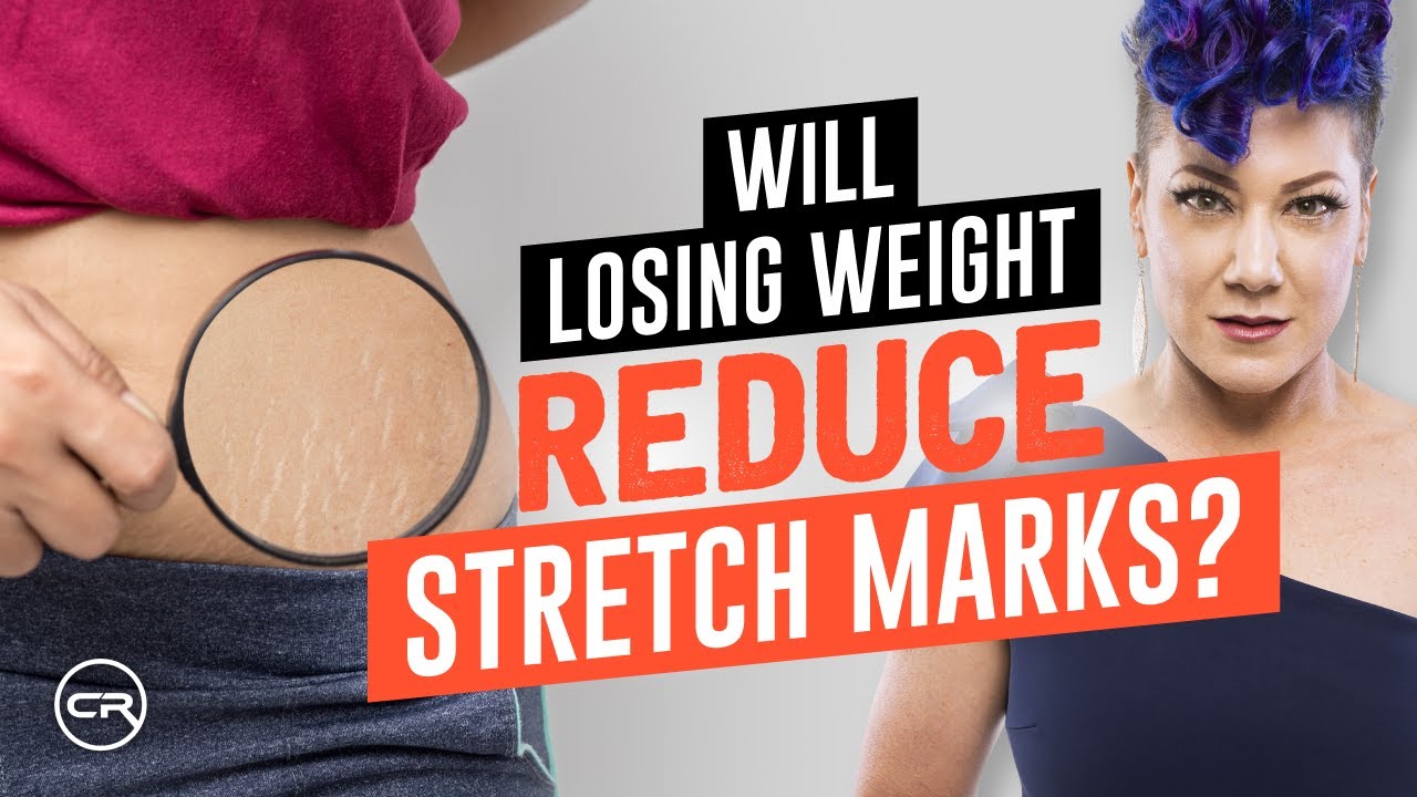Will Stretch Marks Go Away After Losing Weight