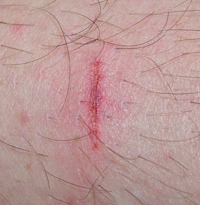 Wound Injury Time Heals All Wounds - Free photo on Pixabay - Wound Closure Medical Devices Product Pipeline Market